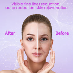YourMate tongue tube attachment for the T-zone skincare