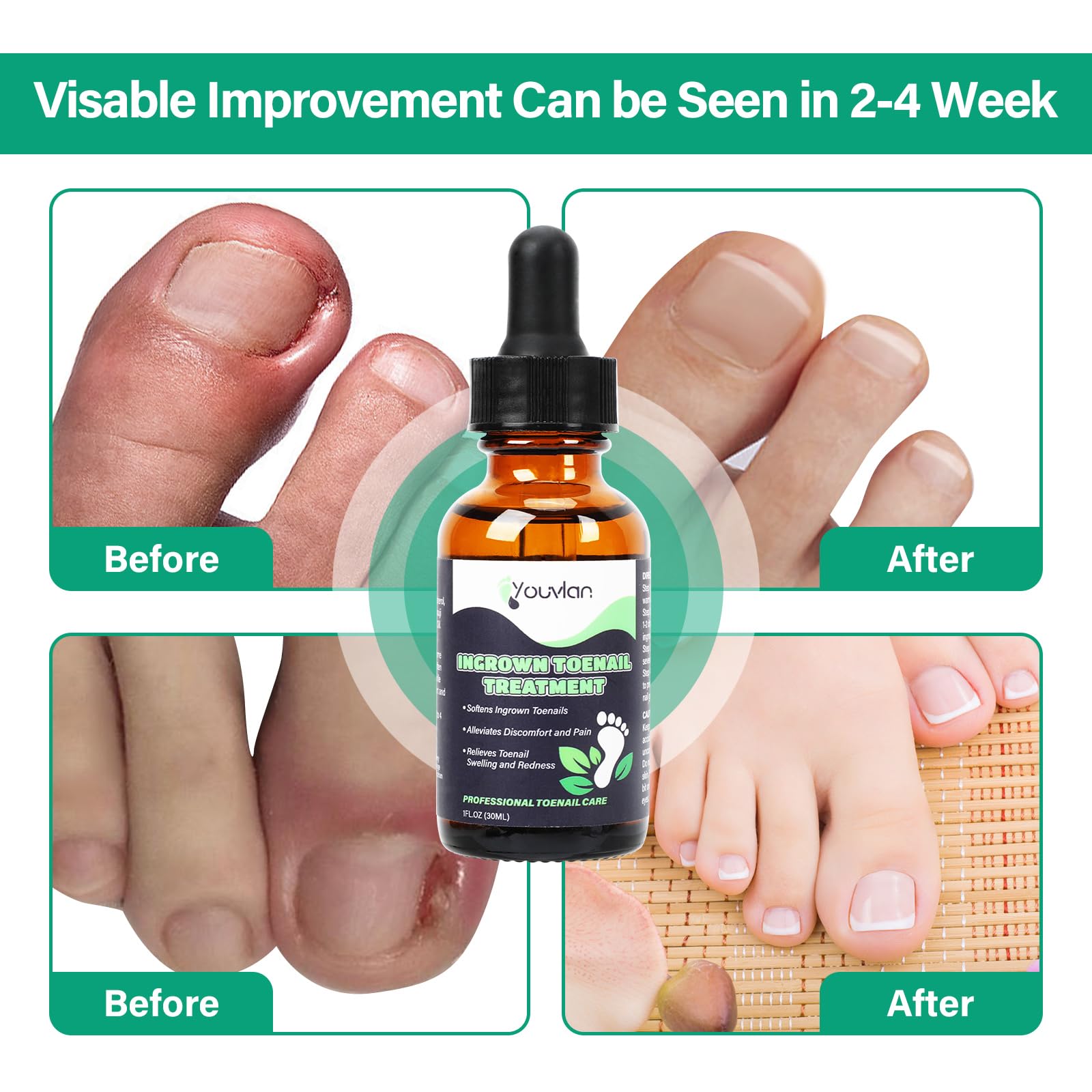 YOUVLAN complete home-use kit supports healthy toenails during regular care.