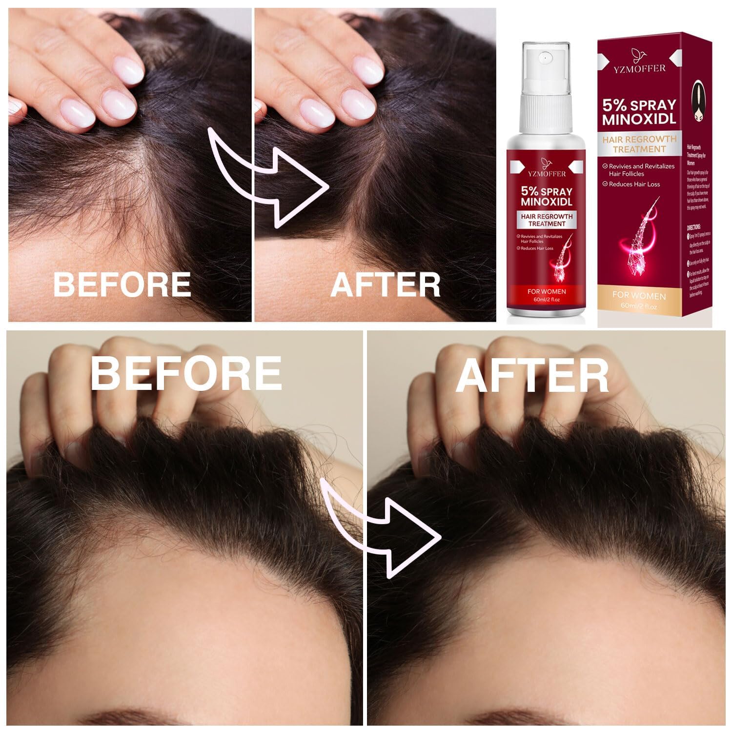 Yzmoffer 5% Minoxidil Spray after-use hair appearance improvement.