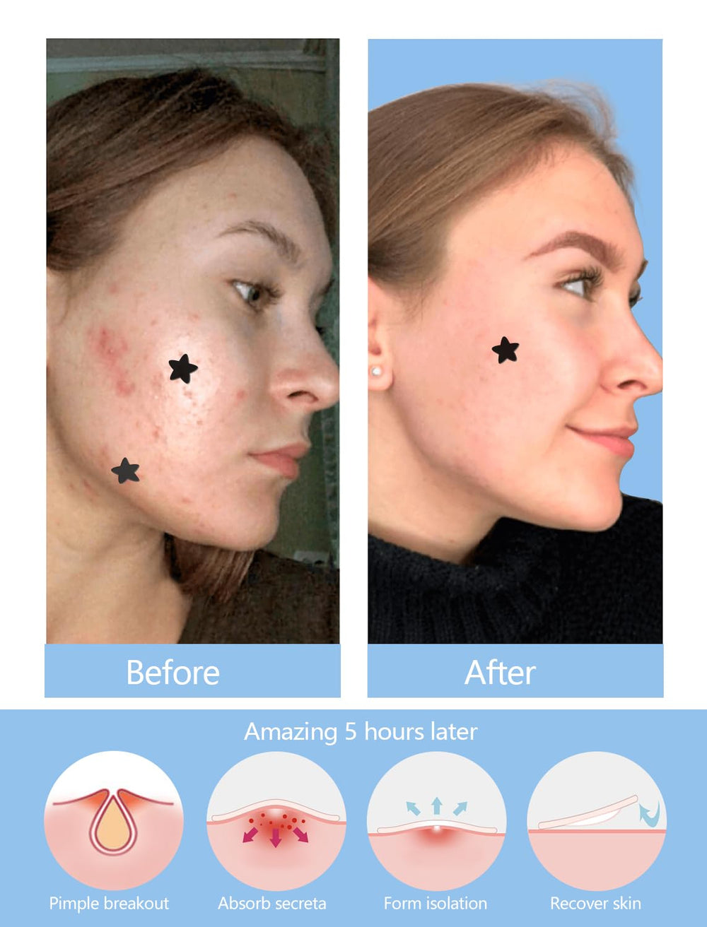 Cica oil and plant extracts complement ZHAOLIESM star patches for sensitive skin.