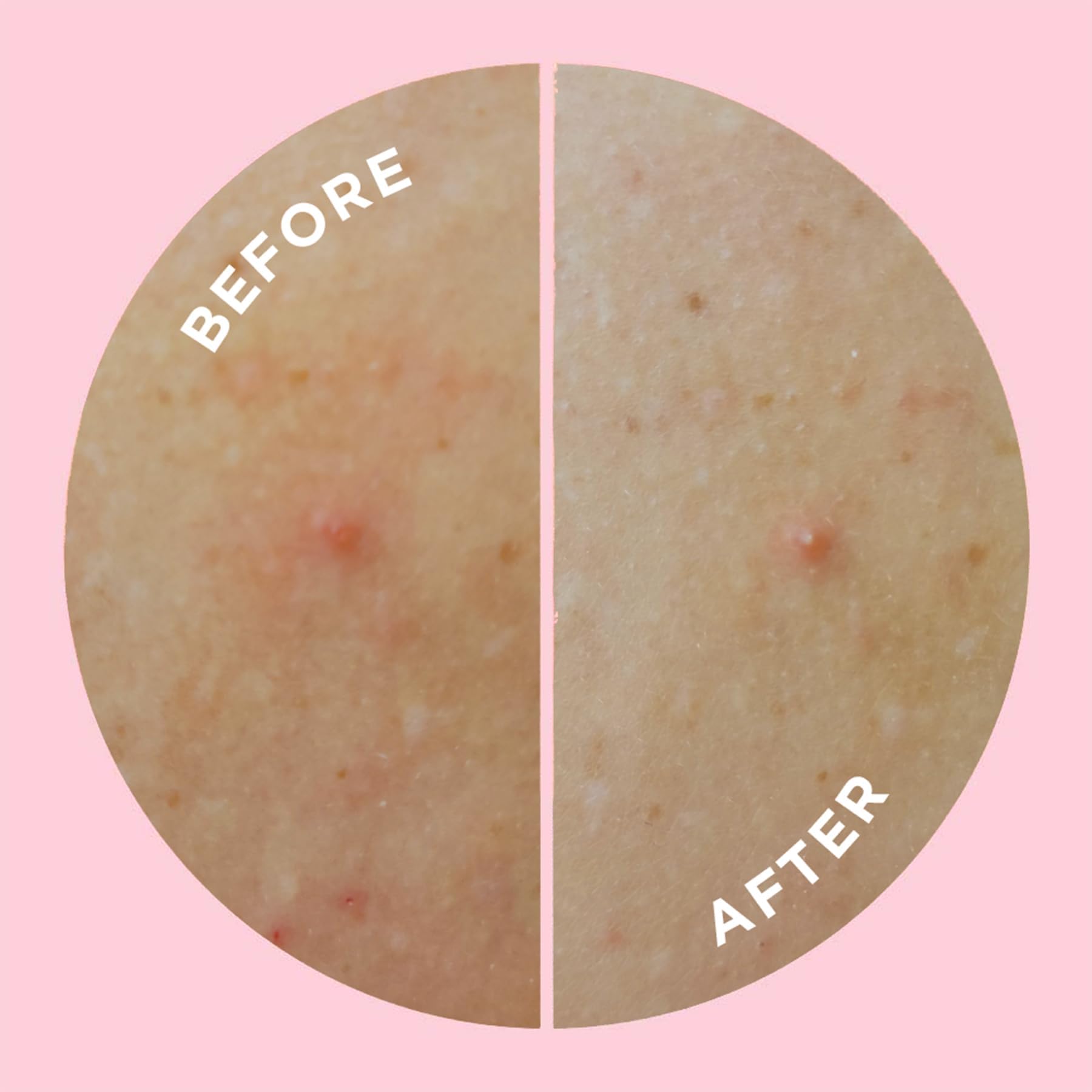 ZitSticka Goo Getter 9-pack display for convenient body-patch care on the go.