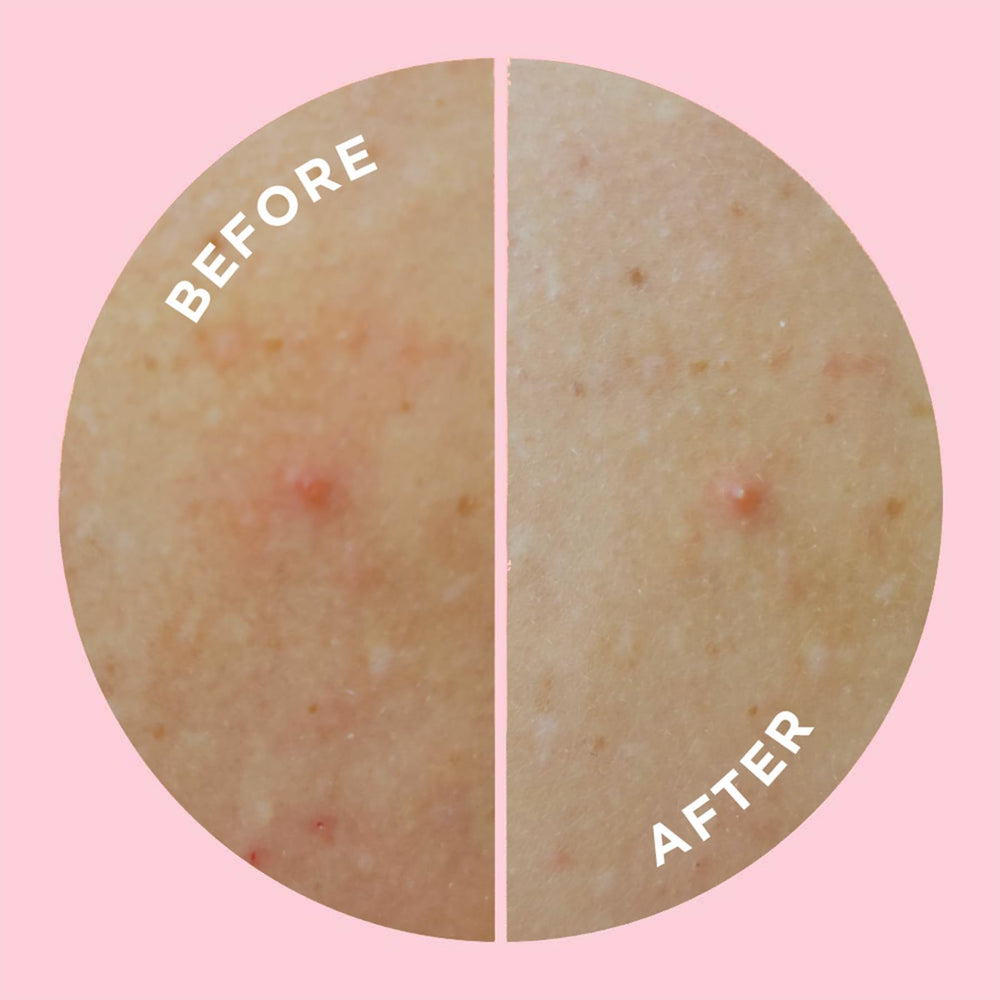ZitSticka Goo Getter 9-pack display for convenient body-patch care on the go.
