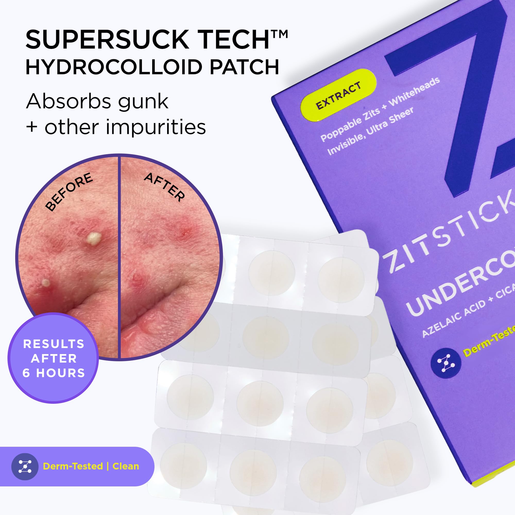 ZitSticka Undercover patch visible on skin highlights hydrocolloid technology.