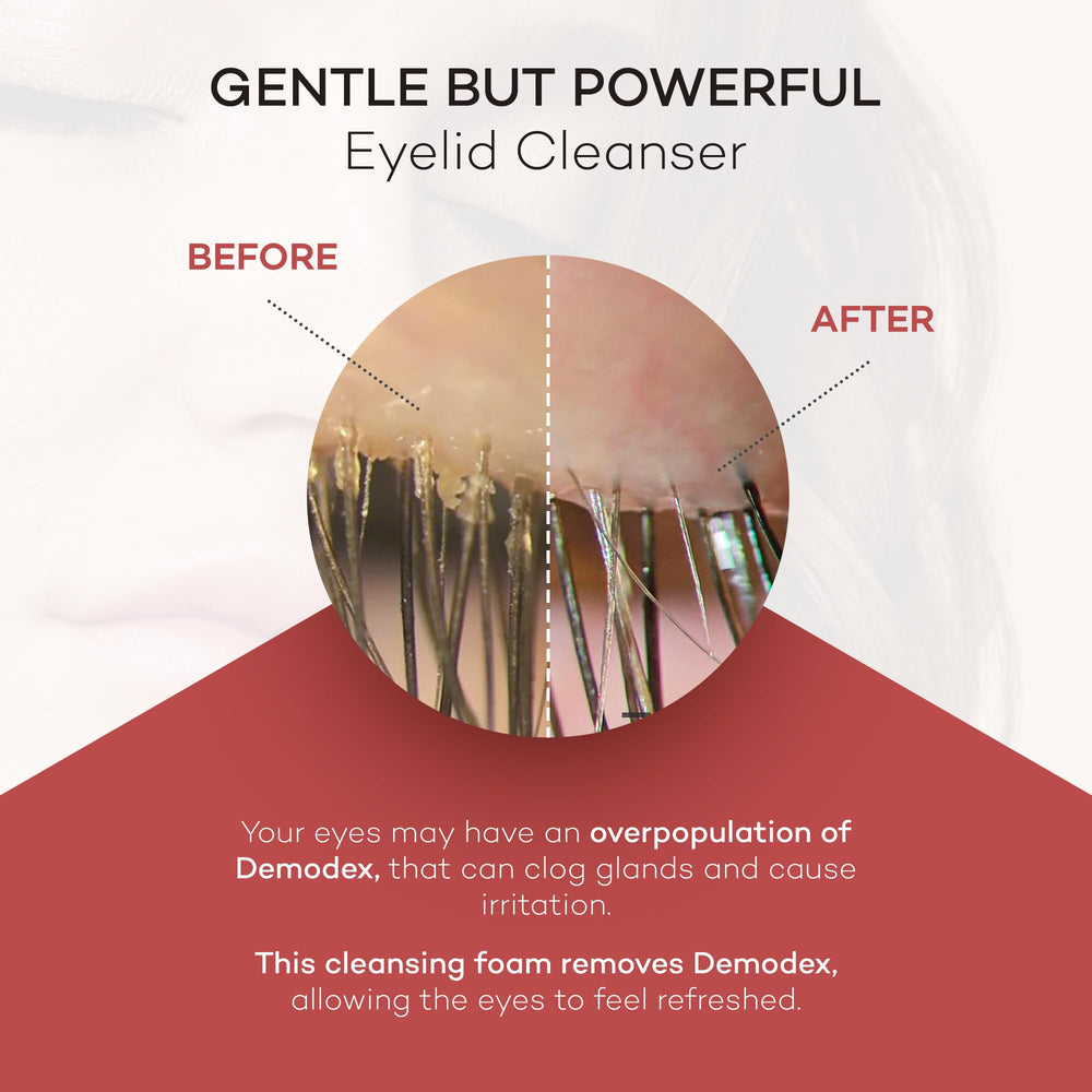 Zocular ZocuFoam promotes dry-eye relief after long screen time.