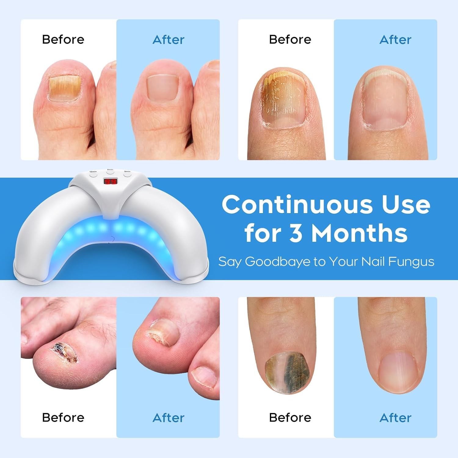 ZZP Nail Repair Solution for damaged nails improving appearance over time